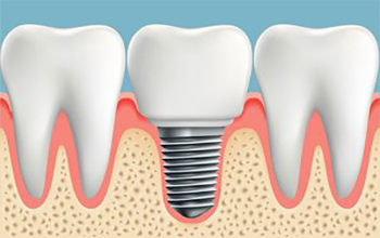 Dental Implant Treatment Nagpur