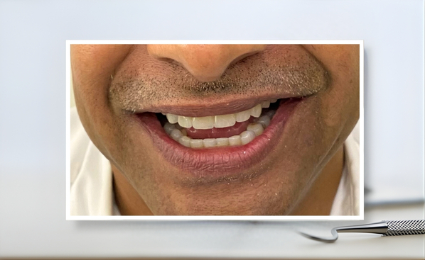 tooth colored filling after