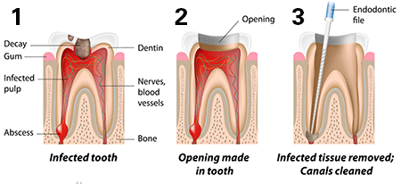 Root Canal Treatment Nagpur