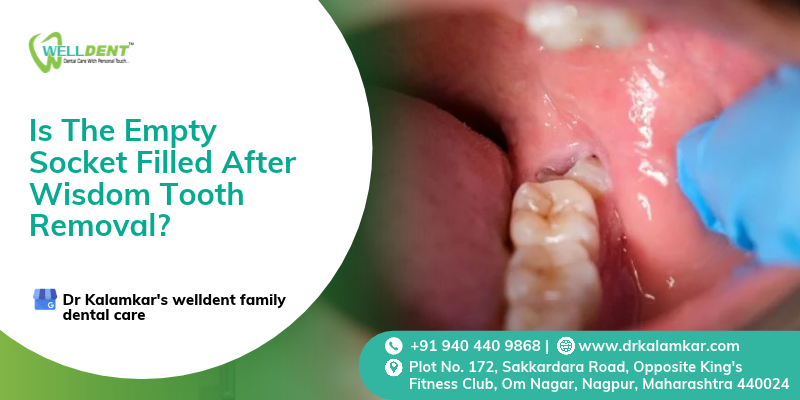 Is The Empty Socket Filled After Wisdom Tooth Removal ?