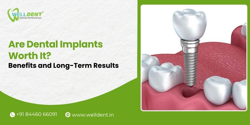 dental implant treatment in nagpur