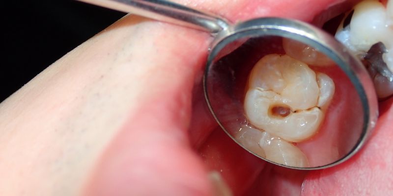 Cavities 101: Causes, Prevention, and Treatment Options