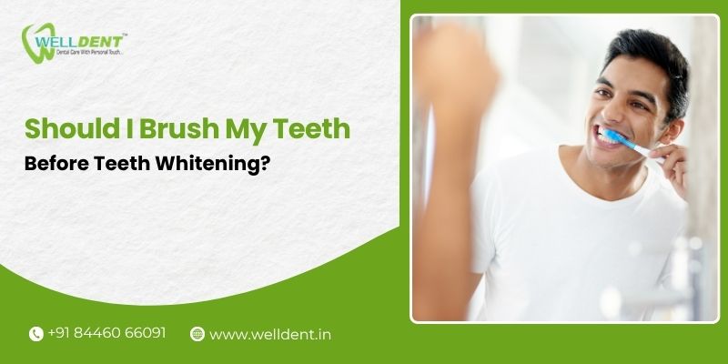teeth whitening treatment in Nagpur
