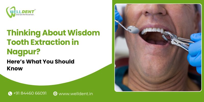 Wisdom Tooth Extraction in Nagpur