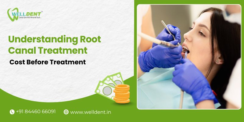 root canal treatment cost in nagpur