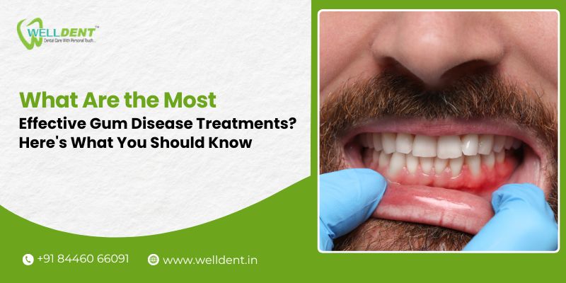 best gum disease treatment in nagpur
