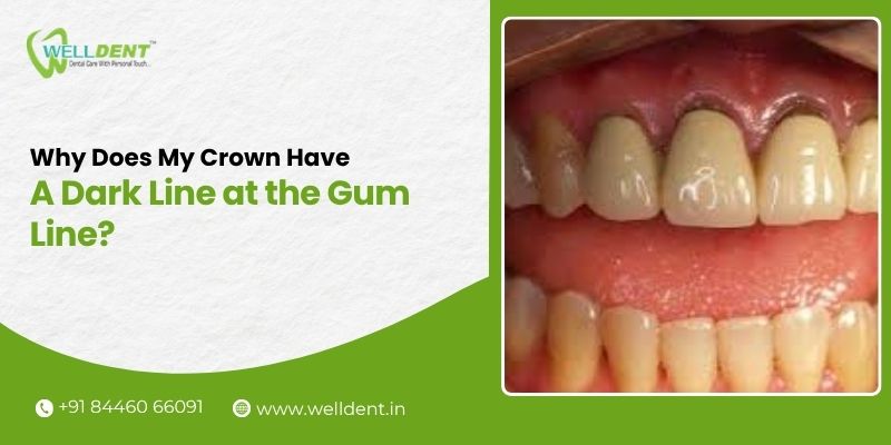 dental crown in vivekanand nagar nagpur